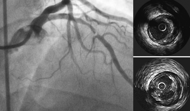 Placca vulnerabile ivus imaging - cardiologia